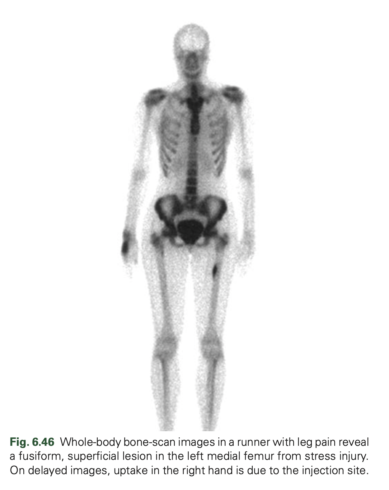 stress-fracture-nuc-med-clinics